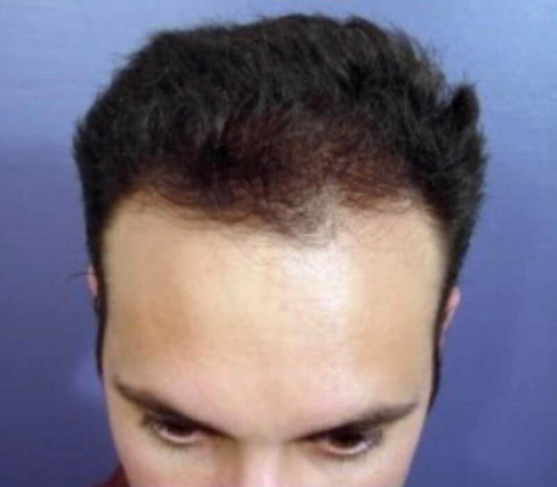 Neograft hair transplant Before & After Image