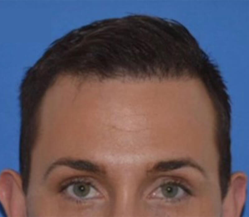 Neograft hair transplant Before & After Image