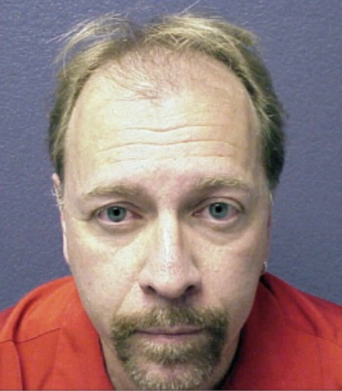 Neograft hair transplant Before & After Image