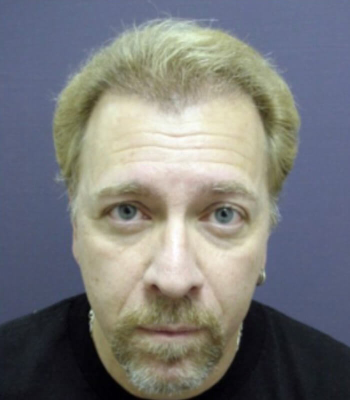 Neograft hair transplant Before & After Image