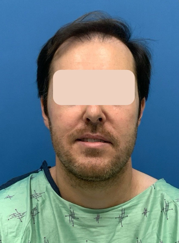 Neograft hair transplant Before & After Image