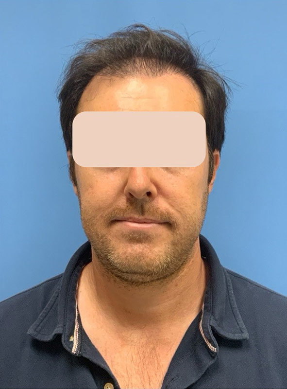 Neograft hair transplant Before & After Image