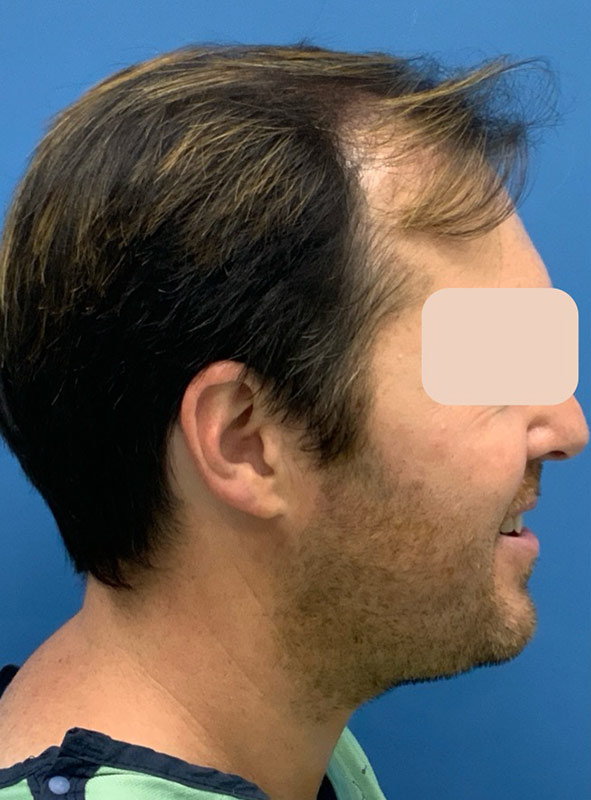 Neograft hair transplant Before & After Image