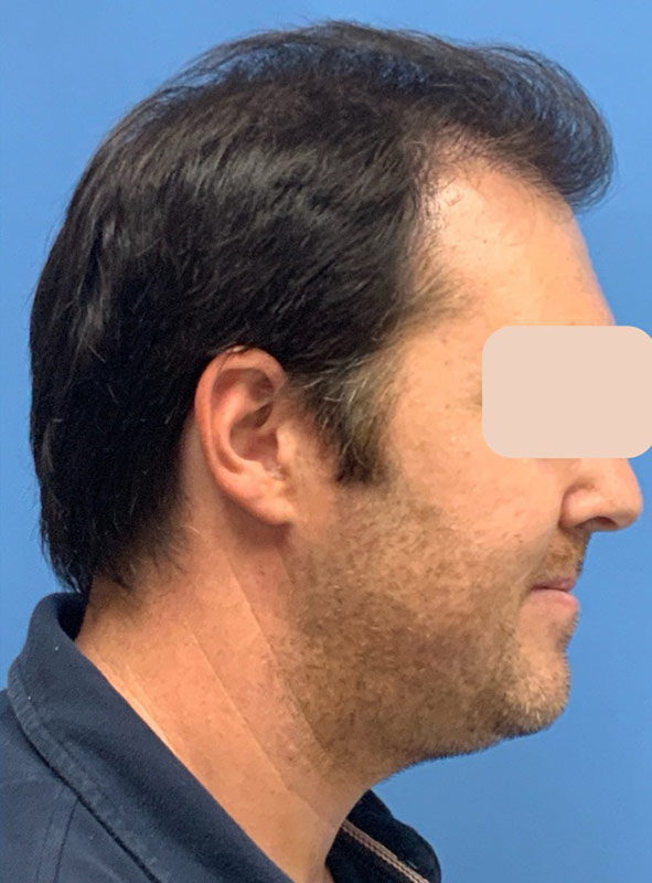 Neograft hair transplant Before & After Image