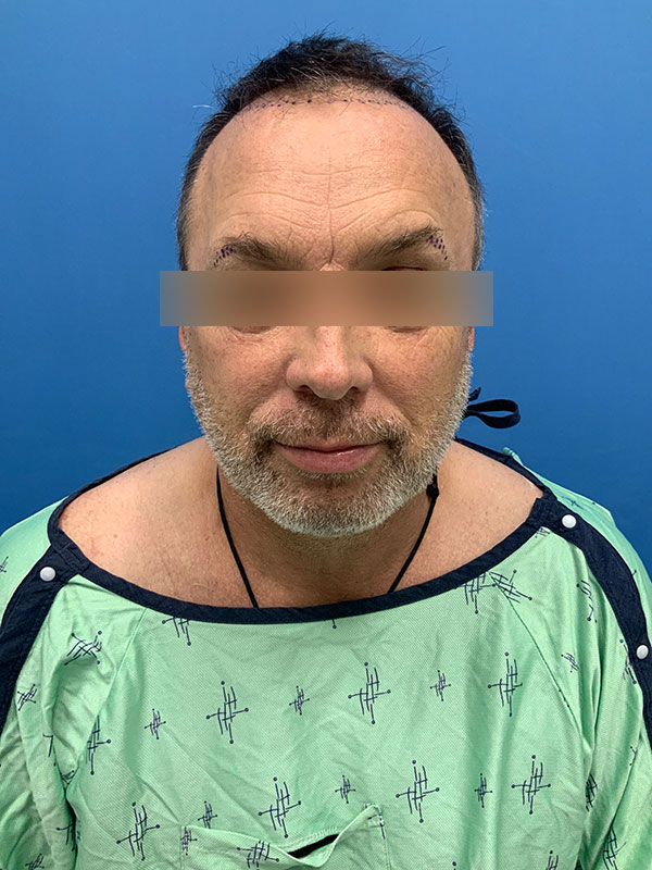 Neograft hair transplant Before & After Image