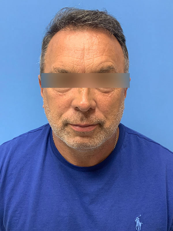 Neograft hair transplant Before & After Image