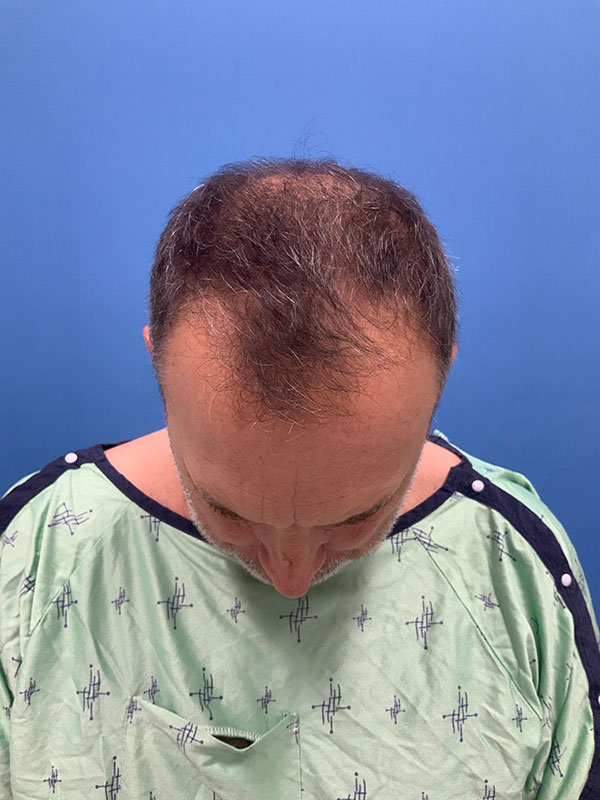 Neograft hair transplant Before & After Image