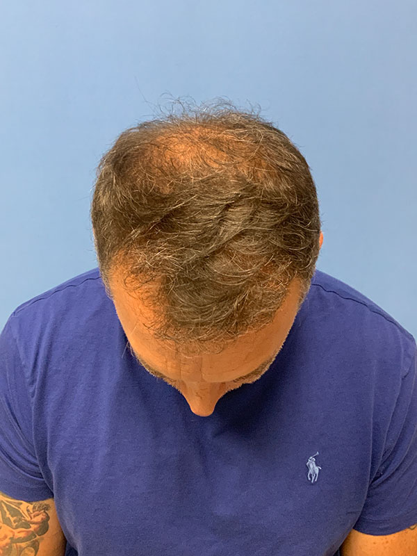Neograft hair transplant Before & After Image