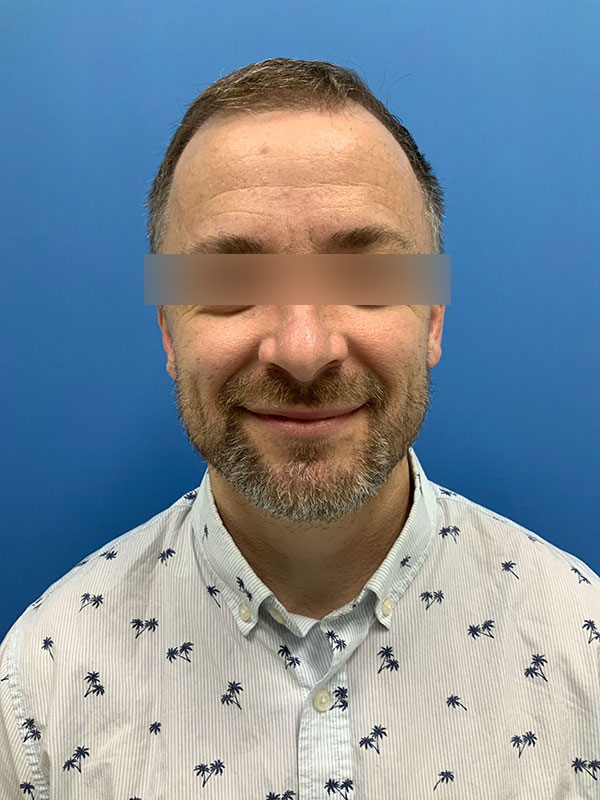 Neograft hair transplant Before & After Image