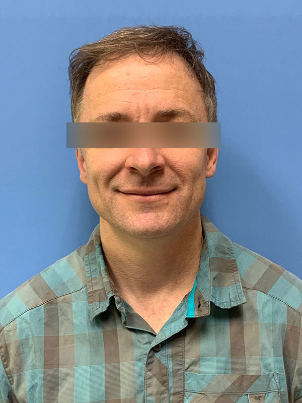 Neograft hair transplant Before & After Image