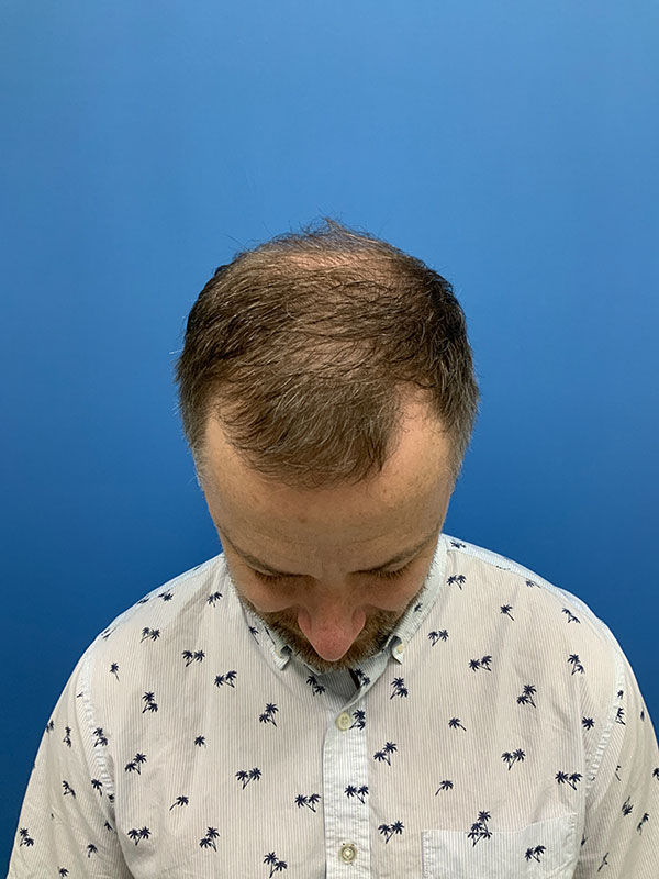 Neograft hair transplant Before & After Image