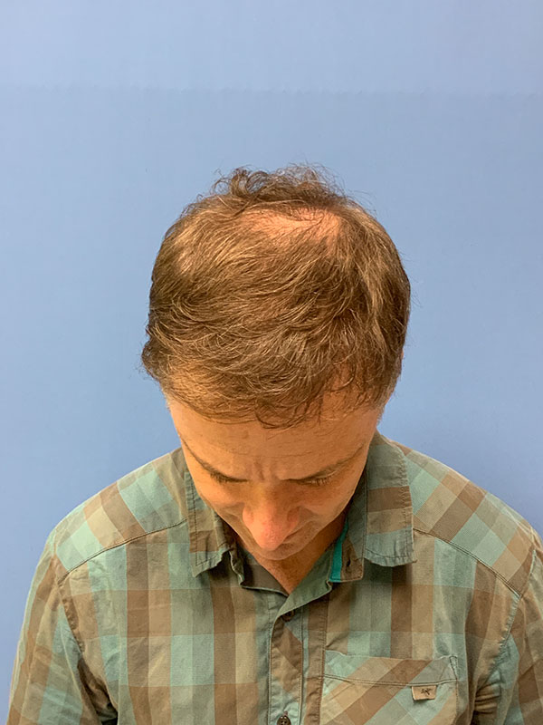 Neograft hair transplant Before & After Image