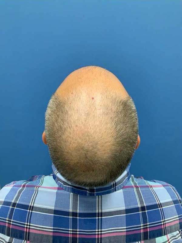 Neograft hair transplant Before & After Image