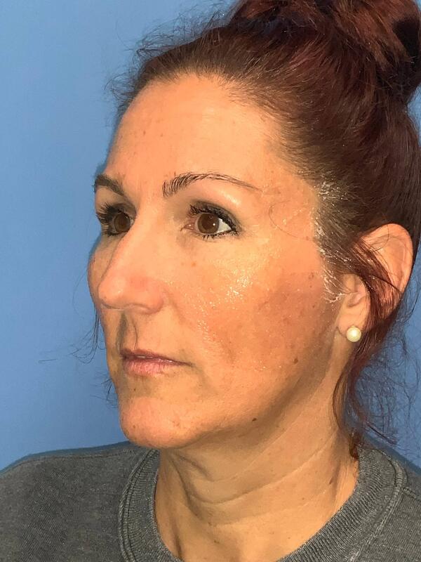 Sculptra Before & After Image