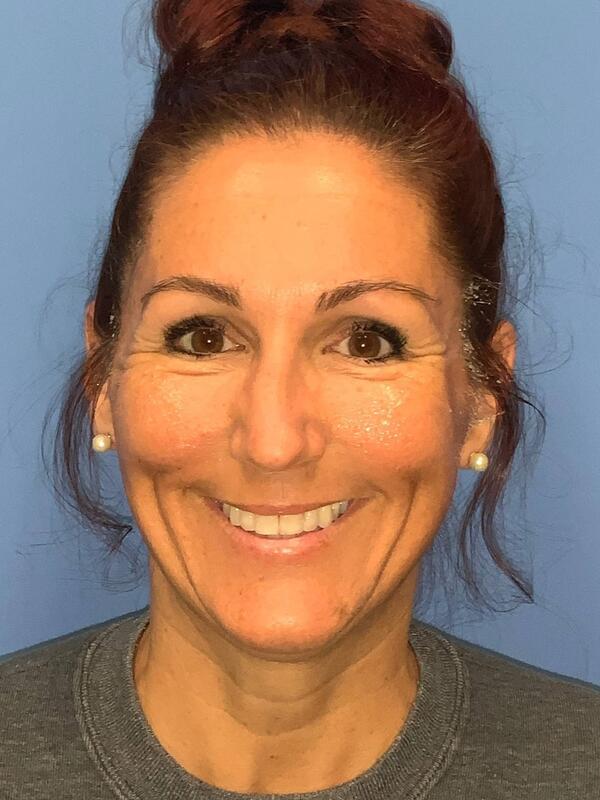 Sculptra Before & After Image