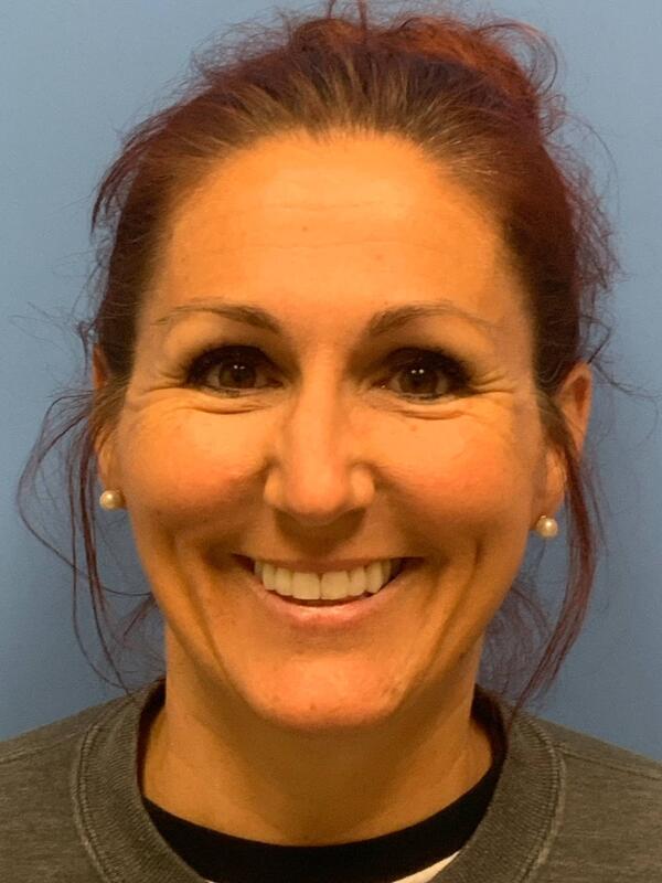 Sculptra Before & After Image