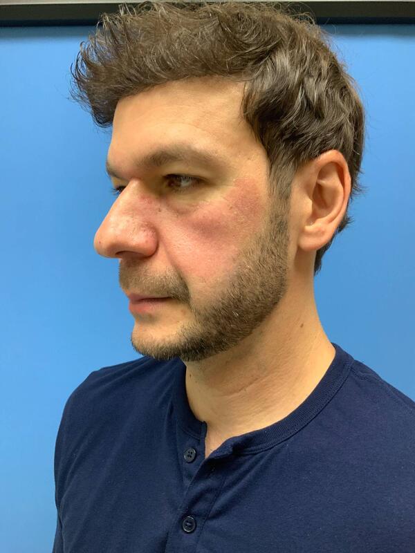 Sculptra Before & After Image