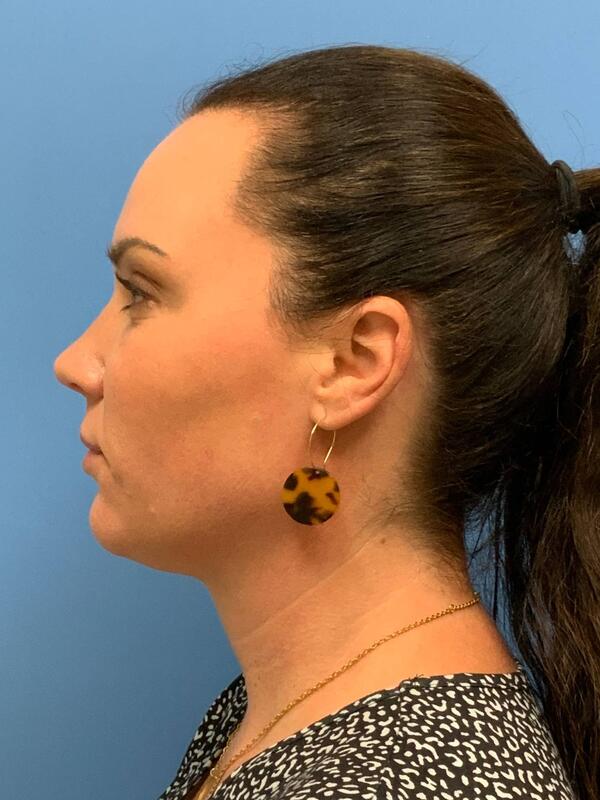 Sculptra Before & After Image