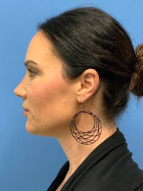 Sculptra Before & After Image