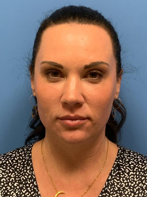 Sculptra Before & After Image