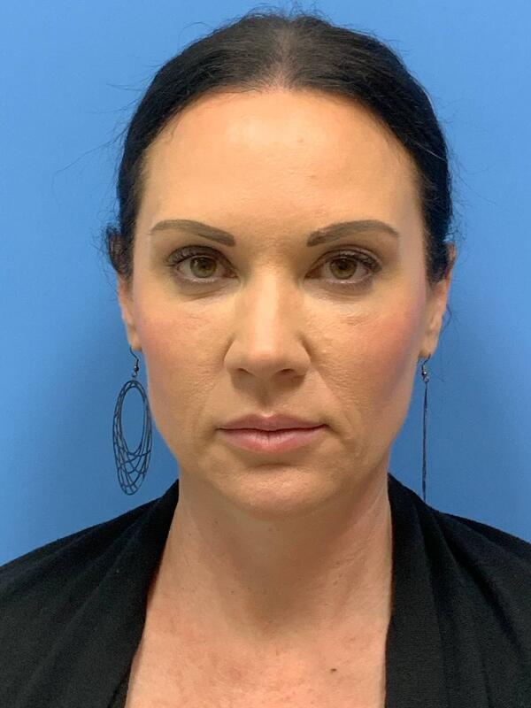 Sculptra Before & After Image